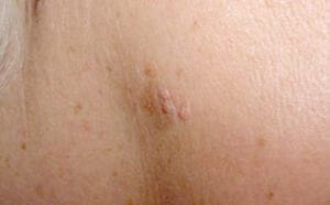 Seborrheic keratoses/åldersvårta/talgvårta/mjällvårta